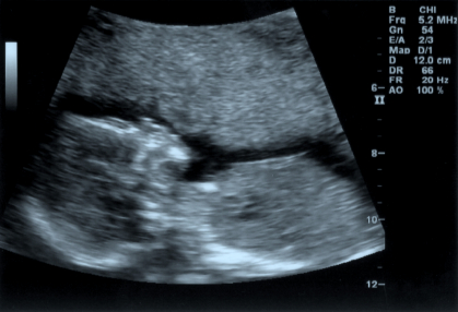 16 Week Ultrasound.