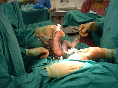 Umbilical Cord.